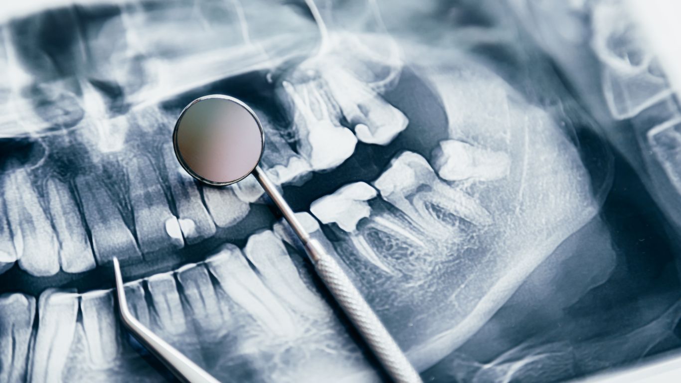 Best supplements for preventing dental cavities